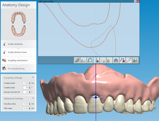 Using Digital Dentures Resins | Formlabs